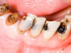 Điều trị bệnh lý răng miệng